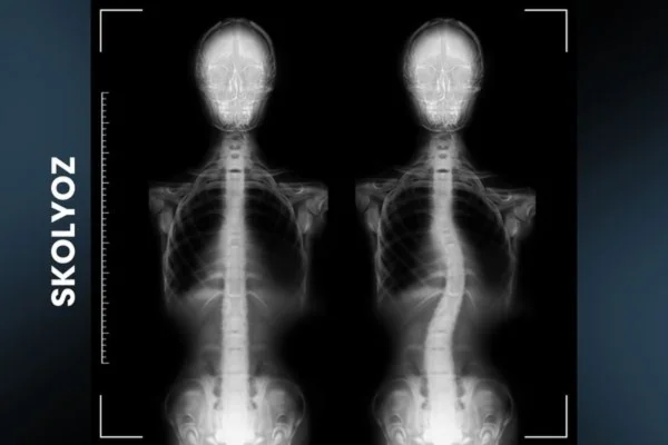 Skolyoz (Omurga Eğriliği) Erken Teşhisin Önemi