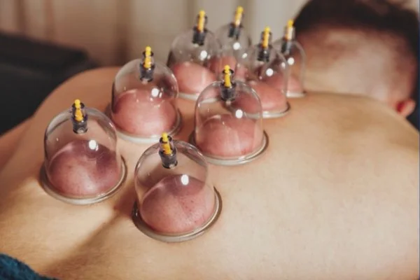 Kupa Terapisi (Cupping) ve Hacamat Arasındaki Farklar