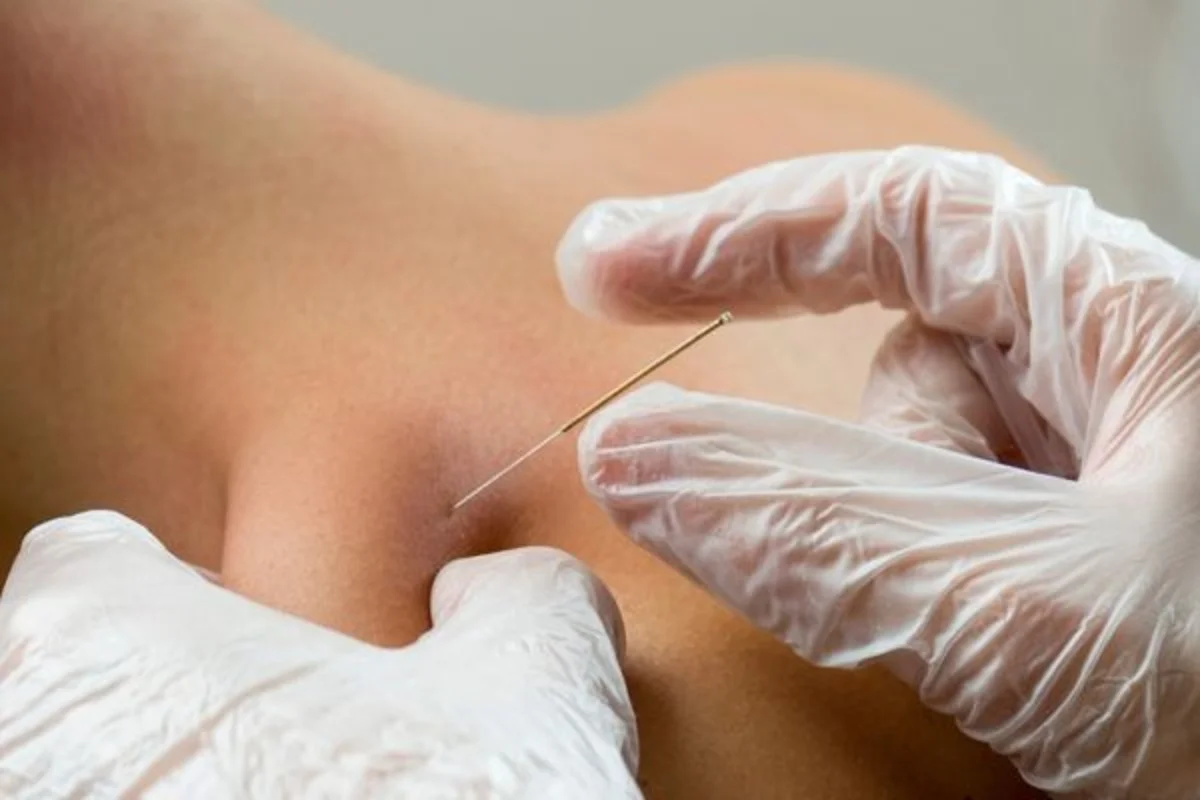Kuru İğneleme (Dry Needling) Hangi Hastalıklarda Kullanılır?