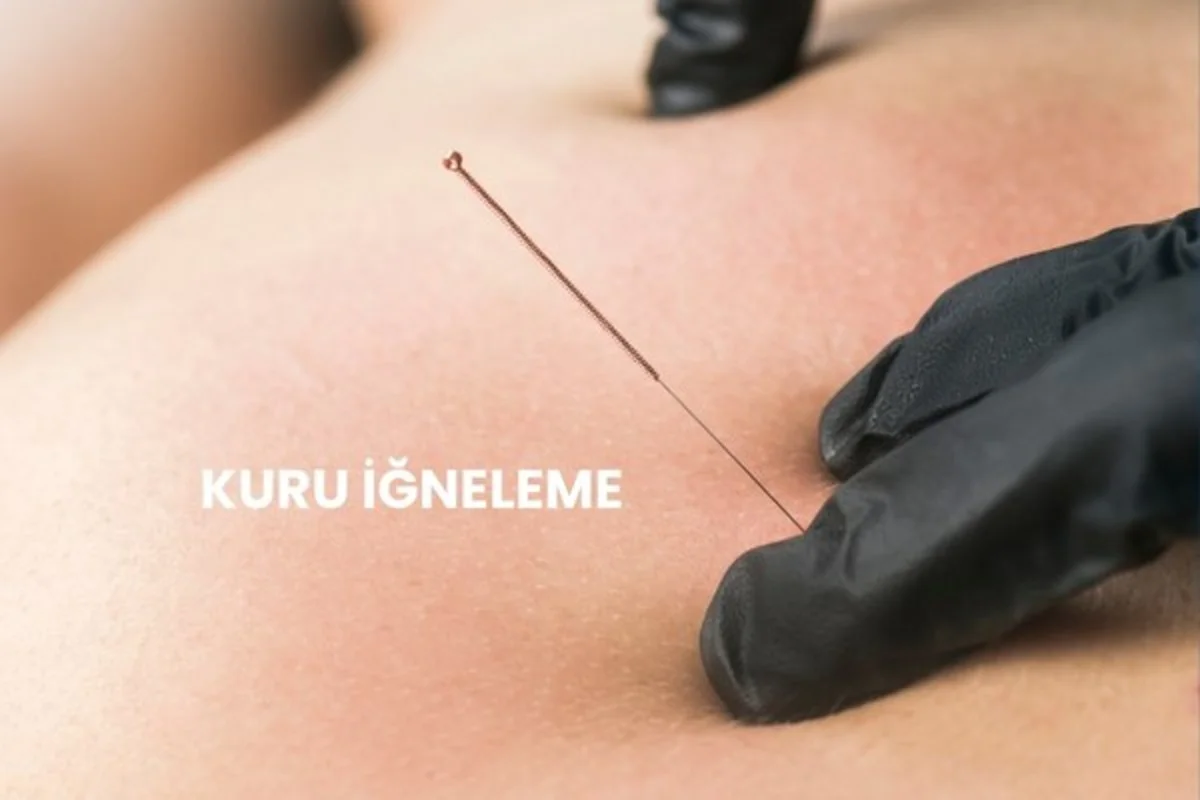 Kuru İğneleme (Dry Needling) Nedir? Mucize mi, Tedavi mi? Yan Etkileri Var mı?