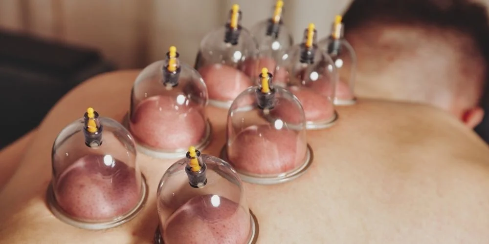 Kupa Terapisi (Cupping) ve Hacamat Arasındaki Farklar