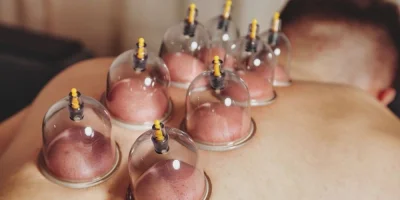 Kupa Terapisi (Cupping) ve Hacamat Arasındaki Farklar