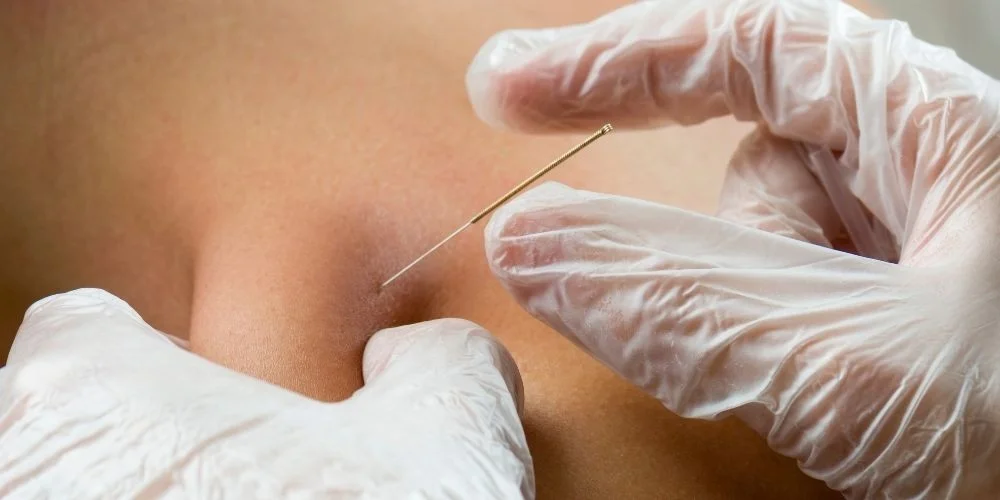 Kuru İğneleme (Dry Needling) Hangi Hastalıklarda Kullanılır?